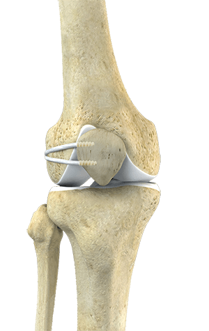 Medial Collateral Ligament (MCL) Tear Englewood