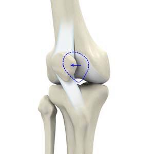 Are You at a High Risk of Suffering a Patellar Dislocation? - New